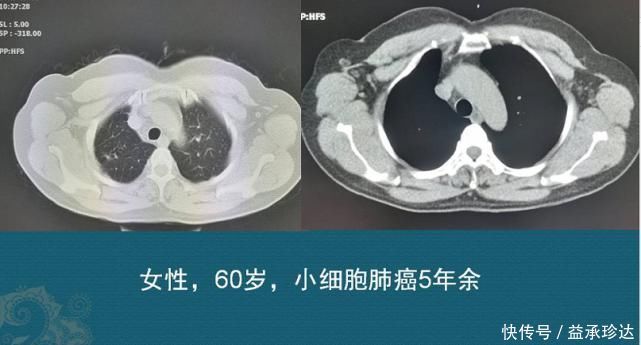 放化疗|查出癌症不放疗不化疗，保持良好心态吃喝玩乐，能扛过去吗
