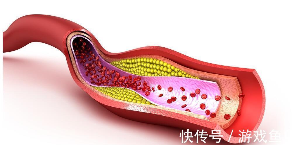 动脉狭窄|如何让动脉狭窄减轻?降低血脂,能使粥样硬化斑块变小吗?