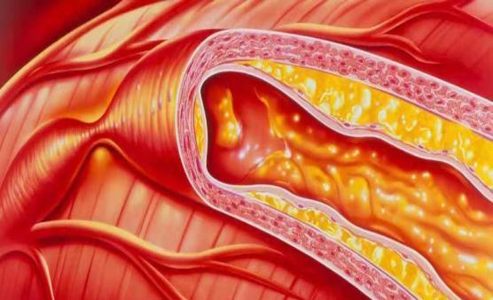 血管|高血脂“克星”公开,避免做这几件事,血管干净通畅