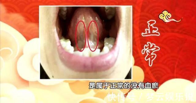 痰湿|血瘀生百病!中医推荐4个活血化瘀宝贝,针对不同的血瘀体质!