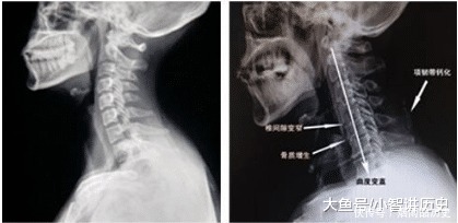 颈椎病反复不好，一样小物就能解决，身边有颈椎病的可以保存了