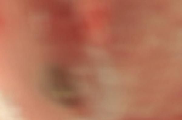 家长|男童好奇误吞纽扣电池后送医，家长觉得没大碍直接抱回家