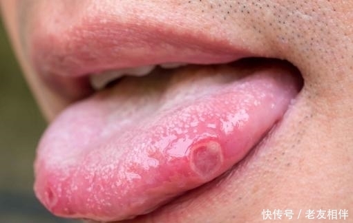 情况|当舌苔出现这5种情况时,暗示你将“疾病缠身”,需警惕!