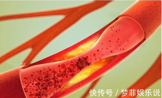 小动作|血栓,就像游走在血管里的幽灵!它竟然最怕这5个小动作!