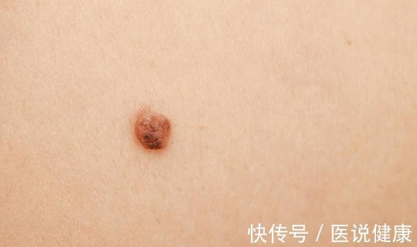 色素痣|皮肤上出现了红痣,还伴随这4种情况,当心是皮肤肿瘤找上门了