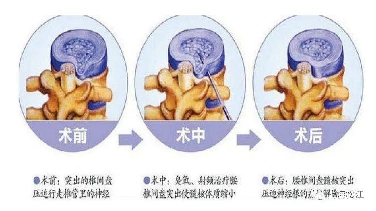 颈椎病患者|肩痛、手麻，是颈椎病？不一定！来看解答→