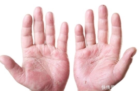 表现|肝不好手上一旦出现4种表现,是肝脏在求救,别不当回事