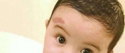 添加剂|不想宝宝出生后有胎记?孕期尽量避开三点,或许有助于胎儿发育