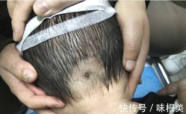寄生处|“小血痂”竟然是孩子的夺命虫!医生:幸亏发现的及时