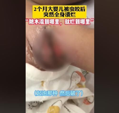 妈妈|两个月婴儿全身溃烂有脓,妈妈称家里不关窗,被“毒虫”趁虚而入
