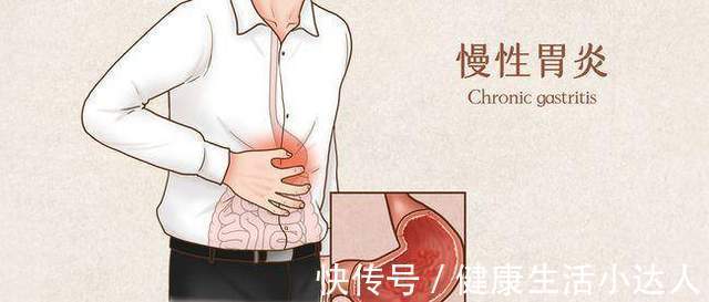 小左|23岁姑娘,胃疼2周没重视,确诊胃癌,要全胃切除,医生惋惜