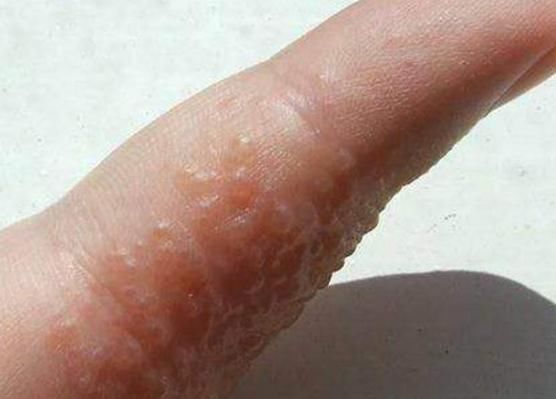 疱疹|手上出现此类“水泡”,切莫忽视,多半是“它”要来了!