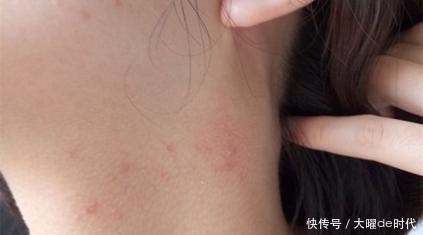 胸前背后总是长痘痘该怎么办?