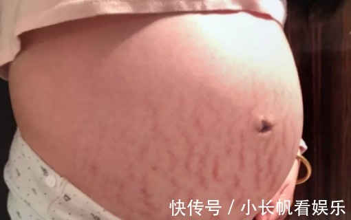 孕期|生个孩子“肚皮开花”,孕期做好掌握这3点,妊娠纹离你远远的