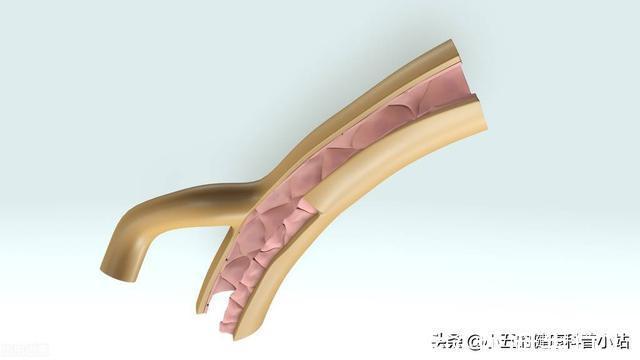 中成药|既能抗凝又能降脂稳定斑块?聊一聊常用的中成药——通心络胶囊