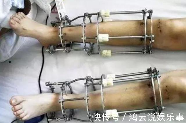 增高|还记得那个花16万、断骨增高7.2厘米的李亚诺吗?后来身体怎样?