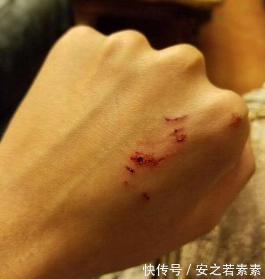 血糖偏高|手脚出现这三种情况 说明血糖高了