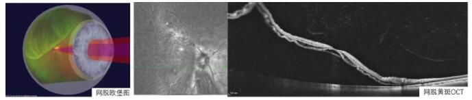 黑点|眼前有小黑点别不当回事，可能是视网膜脱离的第三部曲