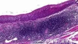 胸骨|明明是慢性咽炎,胃镜查出食管癌!医生忠告:出现这些症状别大意