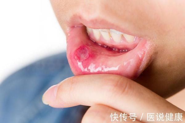 槟榔素|女子连续口腔溃疡一个月,为何最终查出舌癌?这6类人可得当心