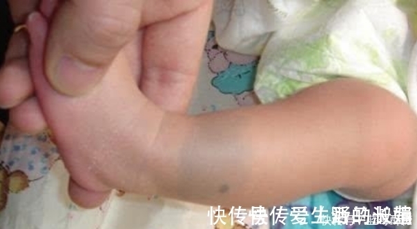 小孩|奇闻!小孩身上的印记竟是这个,原以为是被打的,结果意外