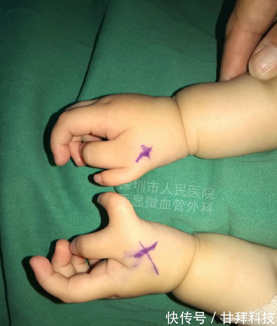 男孩|得了这病,12岁男孩手指比香蕉还粗!7种常见的手部畸形,家长们要注意