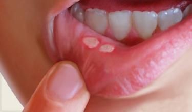口腔疾病|口腔溃疡怎么办？最快最有效的小妙招有哪些？