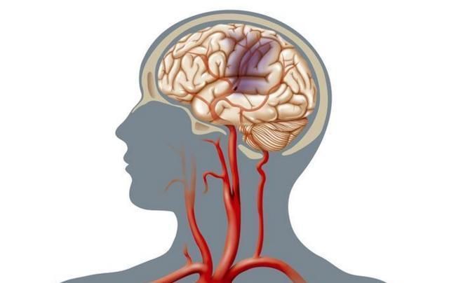  原因|40岁后，脑梗最喜欢4类人，医生：只需做好3事，脑梗就与你无缘