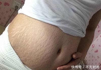 肚子|妈咪生完宝宝后，肚子上会留下难看的妊娠纹，那该怎么办呢？