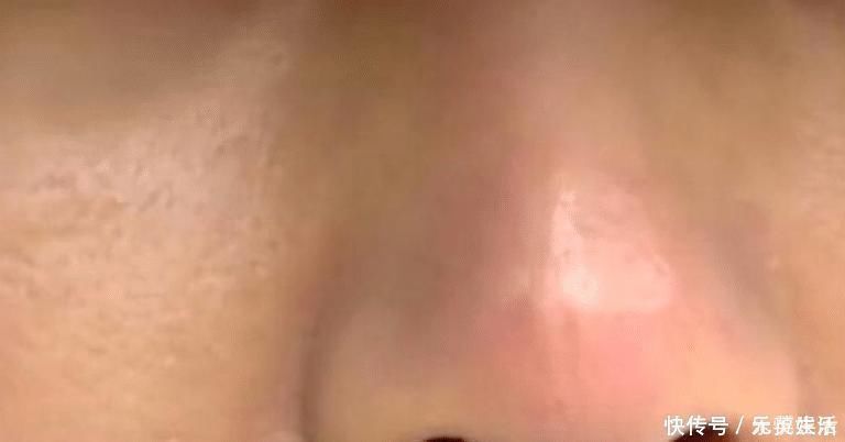 手术 想要鼻子更秀气一点，术后竟然像“果冻”，女子吓得不敢出门