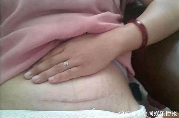 医生|产妇剖腹产不知选择横切还是竖切,医生要美观横切,要二胎竖切