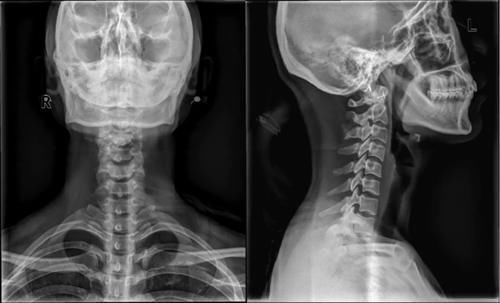 椎体|脊柱常见肿瘤及肿瘤样病变的几种影像学表现,你都见过吗?