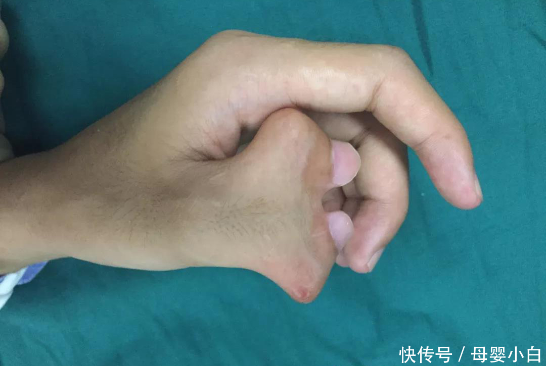 15岁少年先天"蟹钳指"感到自卑 去除多指后自信竖起大拇指