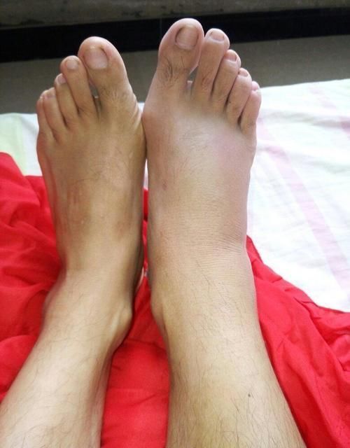 糖尿病患者|冬天泡脚是个好习惯，但也一定要注意方法！