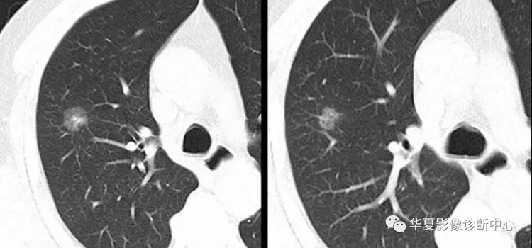 患者|从肺结节到肺癌，10个月影像记录，提醒我们正确对待肺结节处理
