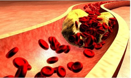 动脉血管|3个人就有1个颈动脉斑块!如何预防和治疗医生说的清清楚楚