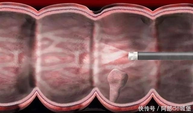 大肠癌|患上大肠癌的第一个信号,常常是这种异常,最好去检查一下