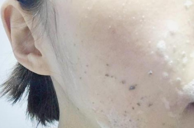 皮肤|87岁院士研究黄褐斑60年，提醒：三种食物易“烂脸”，少吃为好