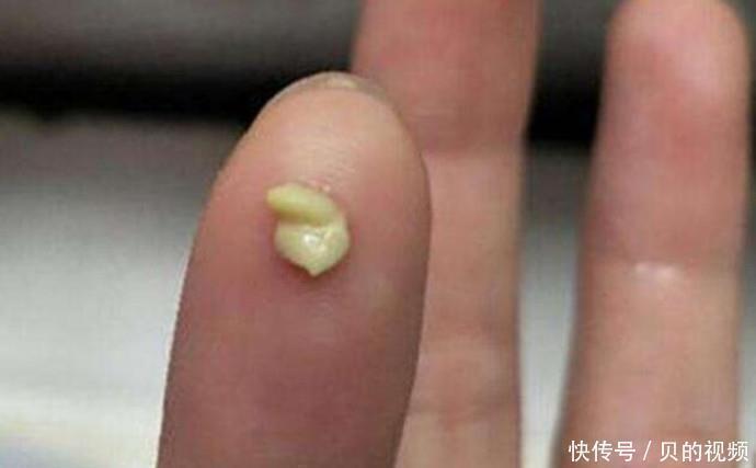 扁桃体|儿子被同学嘲笑“嘴太臭”,带去医院检查后,取出的东西很恶心