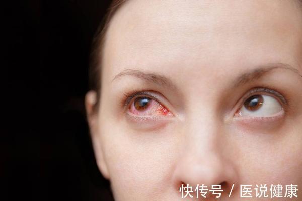 螺旋体|莱姆病的病程有快有慢,发现这5种情况,及时检查,切莫耽误病情