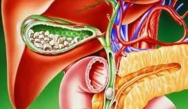 结石|为健康少吃肉，却招来胆结石？