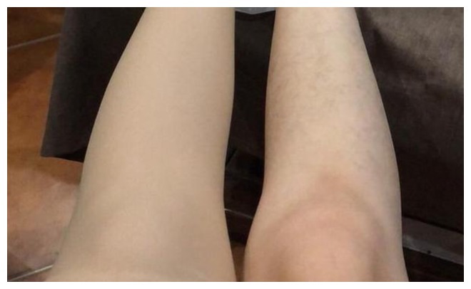 晴雨表|双腿或是血脂的“晴雨表”腿上出现这3种现象,血脂可能偏高了