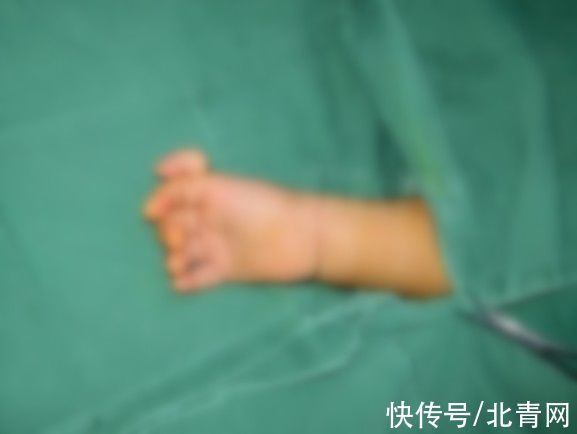 乐乐|双指粘连，12岁男孩手指比香蕉还粗！医生手术挽回手掌功能