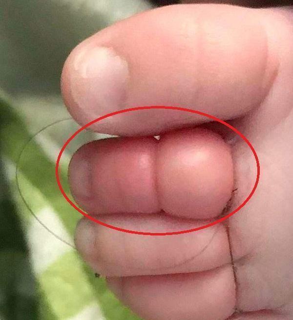 宝宝|1周岁宝宝脚趾进“虫”,宝妈急忙带娃就医,医生:来得及时