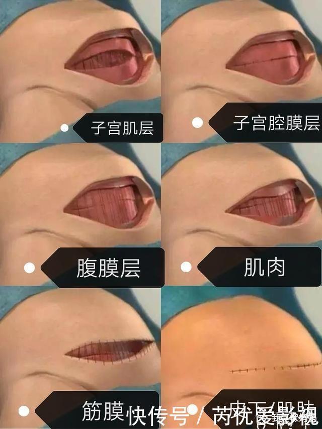 剖腹產|同樣是“一刀”,側切和剖腹產區別有多大?這7大區別你未必想得到
