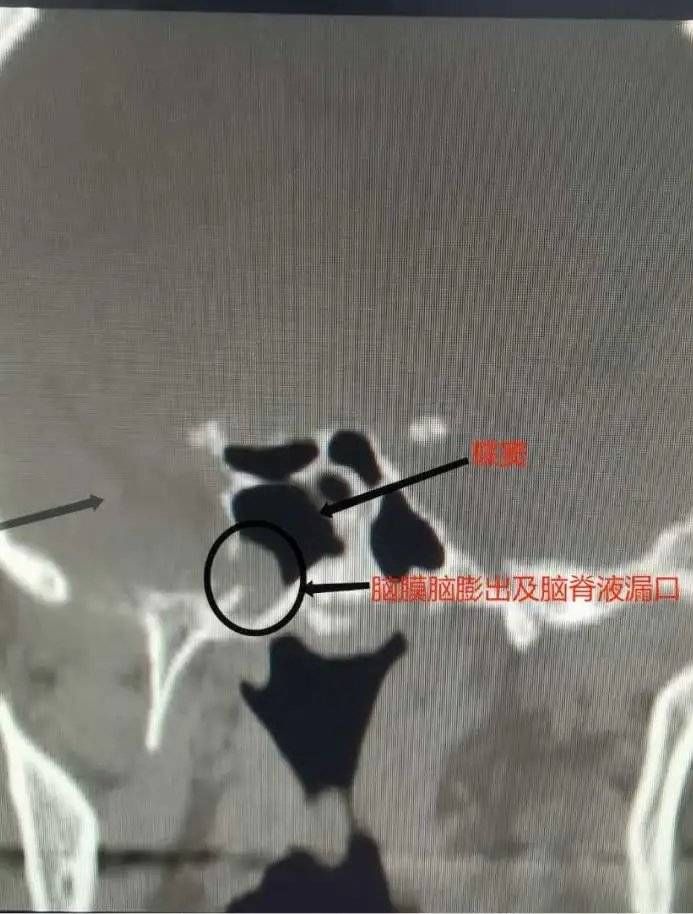 鼻内镜|流“鼻涕”一个多月,竟是脑脊液!鼻内镜下脑脊液修补术解难题