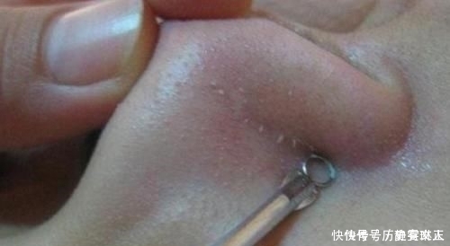 鼻子上挤出“白色条状物”学会这3招,或与“草莓鼻”说拜拜呦