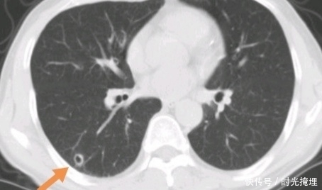 化疗|化疗会造成癌症扩散吗?