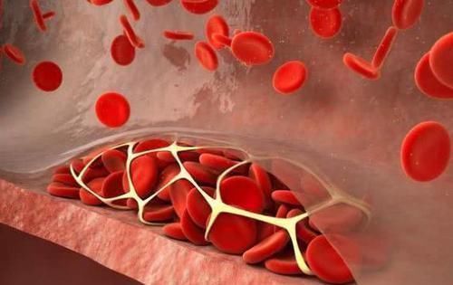 净化|天然的“溶栓王”终于被找到,每天吃一点,净化血液,远离血栓