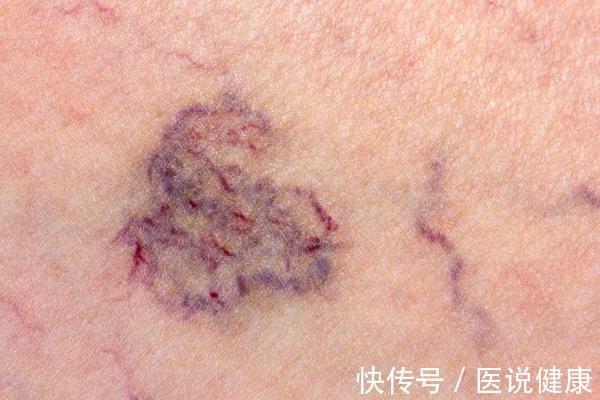 斑块|颈部发生动脉斑块,若选择忽视,这5个后果你或承受不住